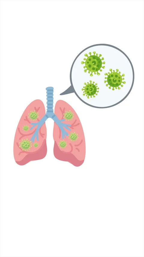 Respiratory virus affecting human lungs Stockbeeldmateriaal 334605466
