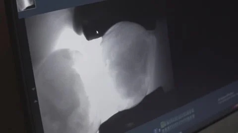 The result of working on a laser screen for dental inspection Stock Footage 148067133