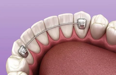 Retainers dental installed after braces treatment. Illustrazione stock