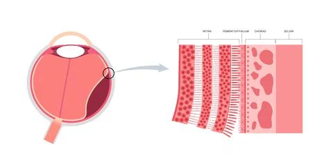 Retinal detachment eye disease Stock Illustration
