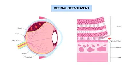 Retinal detachment eye disease Stock Illustration