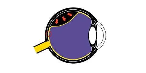 Retinal detachment eye disease Stock Illustration