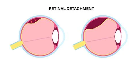 Retinal detachment eye disease Stock Illustration