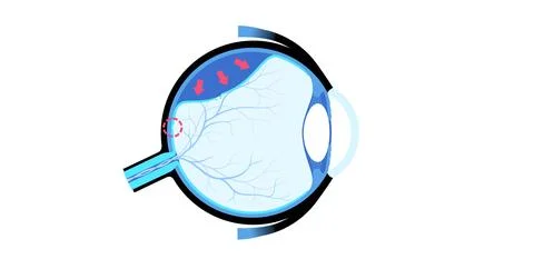 Retinal detachment eye disease Stock Illustration