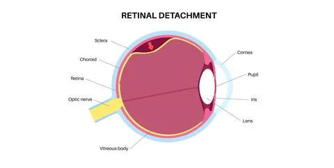 Retinal detachment eye disease Stock Illustration