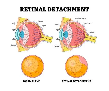Retinal Detachment Eye Vision Problem, Eye Disease for Educational Medical .. Stock Illustration
