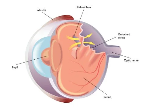 Retinal detachment Stock Illustration