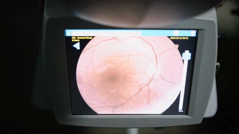 Retinal Scan Showing Optic Disc and Cupping in Eye Exam Stock Footage 314303601