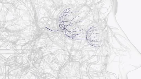 Retinal vein occlusion is a blockage of the small veins that carry blood away Stock Illustration