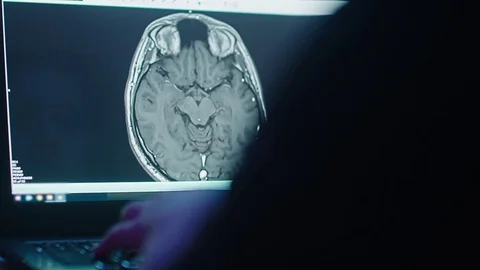 Reveal Single MRI Head Scan on Laptop Pan Left Video stock 82620816