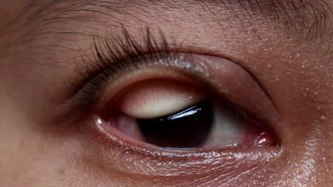 Reverse eyelids Stock Footage 116713423