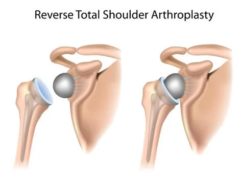 Reverse total shoulder arthroplasty Stock Illustration