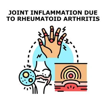 Rheumatoid arthritis causing joint swelling and pain illustration Stock Illustration