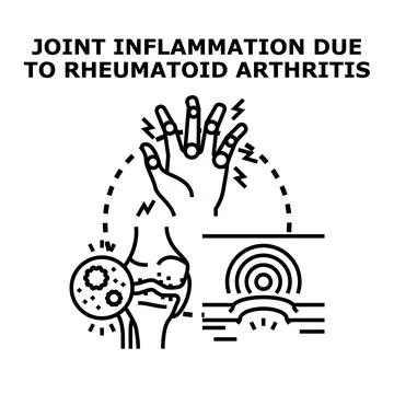 Rheumatoid arthritis causing joint swelling and pain illustration Stock Illustration