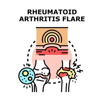 Rheumatoid arthritis flare causing joint inflammation and pain Stock Illustration
