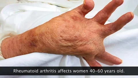 Rheumatoid arthritis Stock Footage 319705056
