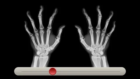 Rheumatoid Arthritis Simulator Screen Stock Footage