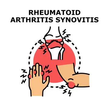Rheumatoid arthritis synovitis affecting human joints Illustrazione stock