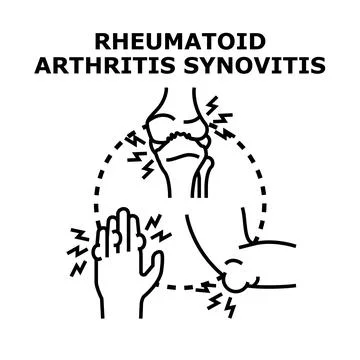 Rheumatoid arthritis synovitis affecting human joints Stock Illustration