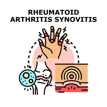 Rheumatoid arthritis synovitis causing joint pain illustration Stock Illustration