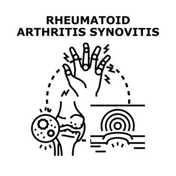 Rheumatoid arthritis synovitis causing joint pain illustration Stock Illustration