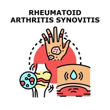 Rheumatoid arthritis synovitis developing joint inflammation Illustrazione stock