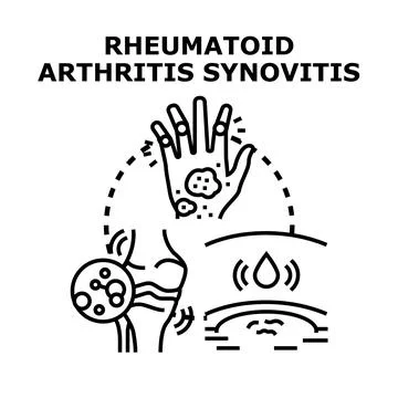 Rheumatoid arthritis synovitis developing joint inflammation Illustrazione stock