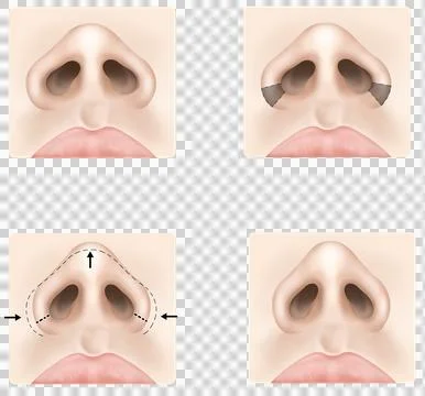 Rhinoplasty 2 Stock Illustration