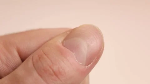 Ridged fingernails with vertical and horizontal ridges. Nails problems Stock Footage 264292947