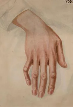 Right hand of a patient whose left median nerve was divided three years pre.. Stock Illustration