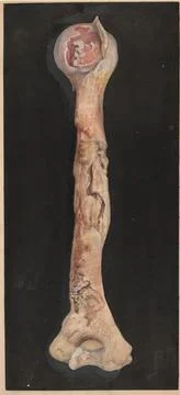 Right humerus from a case of ulceration of the articular ends of the bones Stock Illustration