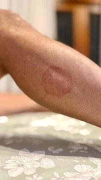 Ringworm Stock Photos