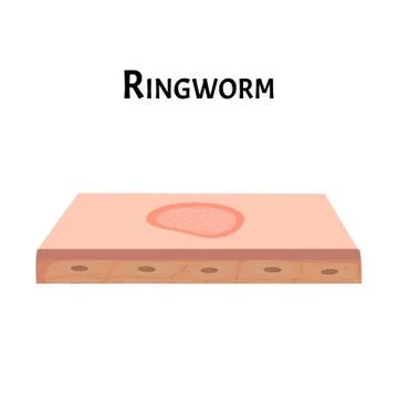 Ringworm on the skin. Vector illustration on isolated background Stock Illustration