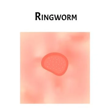 Ringworm on the skin. Vector illustration on isolated background Stock Illustration