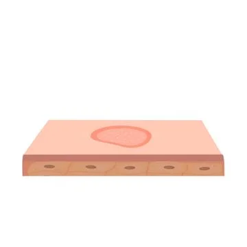 Ringworm on the skin. Vector illustration on isolated background Stock Illustration