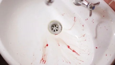 Ripped out the wisdom tooth, bleeding wound Stock Footage 89536596