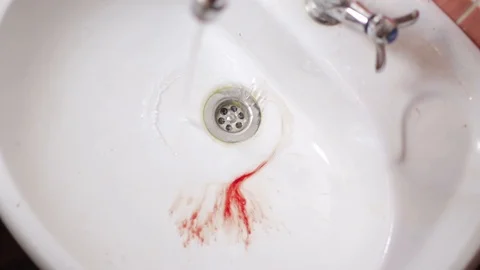 Ripped out the wisdom tooth, bleeding wound Stock Footage 89536653