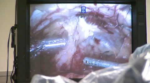 Robotic Surgery 3 Stock Footage 22843789