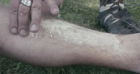 Roman medicus applying an ointment over the skin of the foot of a soldier su Stock Footage 154203865