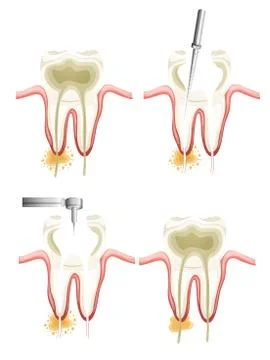 Root canal procedure Stock Illustration
