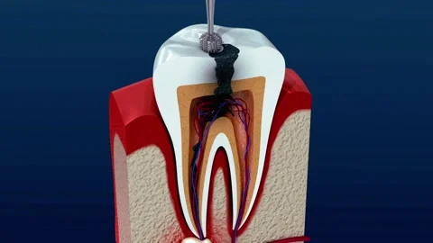 Root Canal Procedure: Tooth Pulp Treatment Animation Stock Footage 327666871