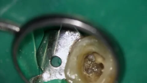 Root canal procedure visualization described. Endodontic access with mirror and Stock Footage 343946840