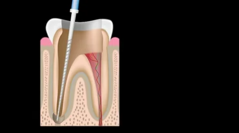 Root canal treatment Video stock 10756818