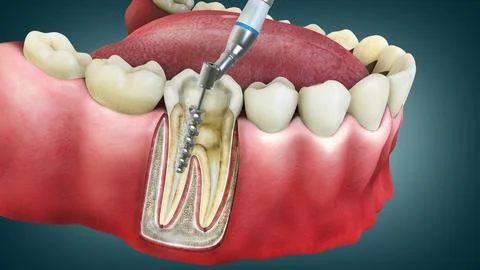 Root canal Treatment Stock Illustration