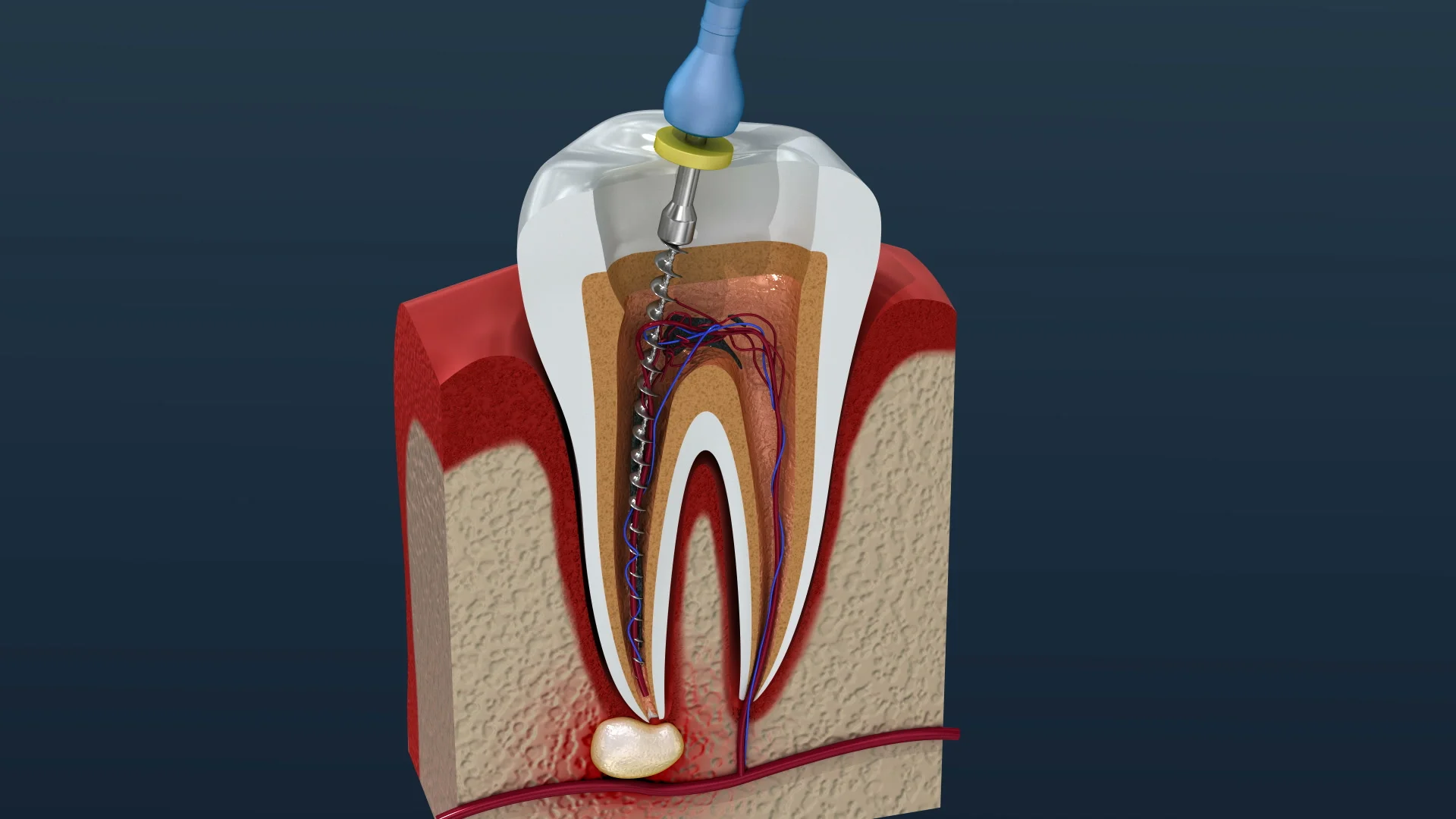 Root canal treatment process. 3D Animati... | Stock Video | Pond5