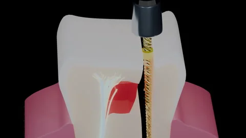 Rotary file cleaning root canal walls in human tooth cross section, 4K Stock Footage 346121218