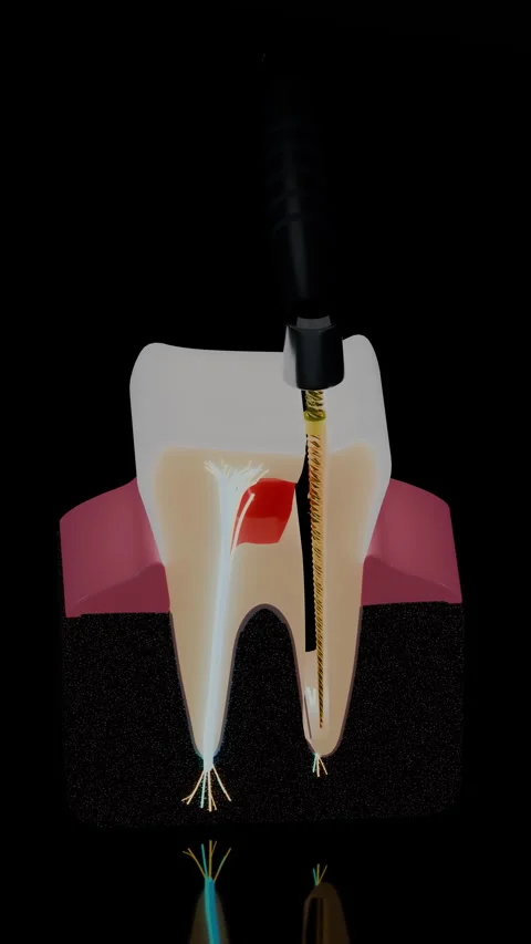 Rotary file in molar root canal with nerve branches in, Vertical 9:16 4K Stock Footage 346120624