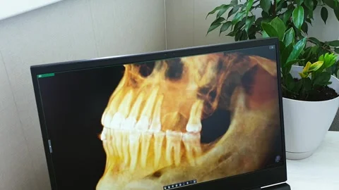 Rotating 3D Amber CBCT Jaw Scan on Screen Showing Missing Teeth. Dental Stock Footage 341284914