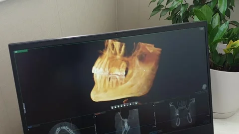 Rotating 3D Amber CBCT Jaw Scan on Screen Showing Missing Teeth. Dental Stock Footage 341286864