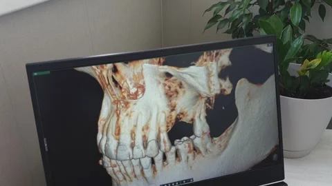 Rotating 3D Dental CBCT Scan on Screen Showing Missing Teeth for Implant Pl.. Stock Footage 341284725